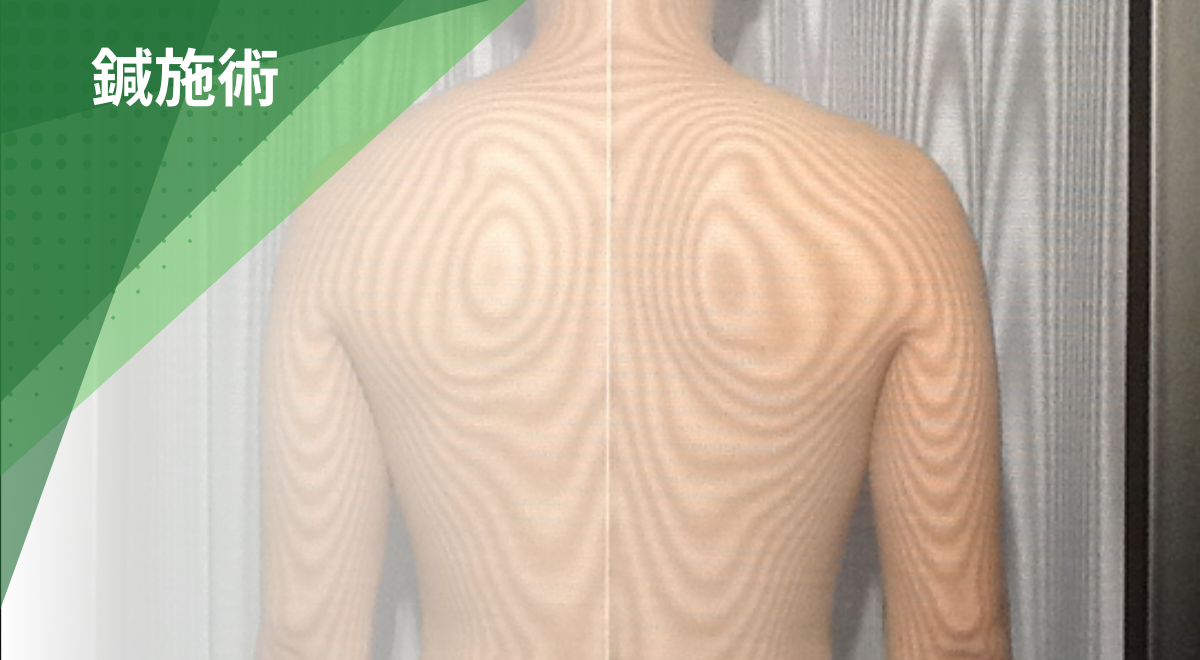 モアレグラフィーで背骨や姿勢の歪みを確認する検査